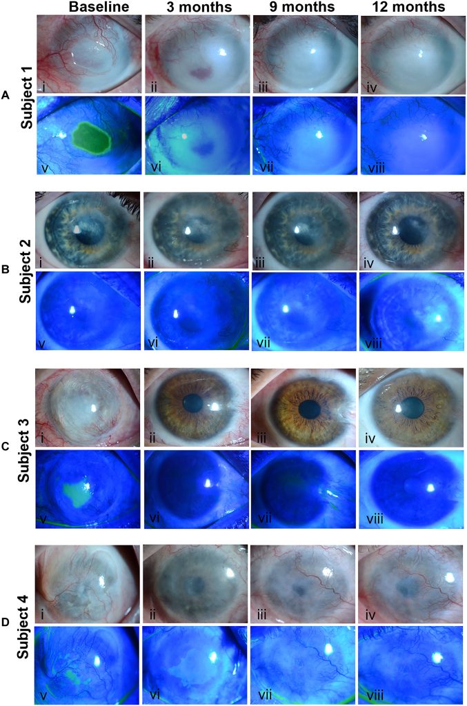 Les images de l'évolution de leurs yeux sur la période de douze mois suivant le traitement à base de cellules souches CALEC.